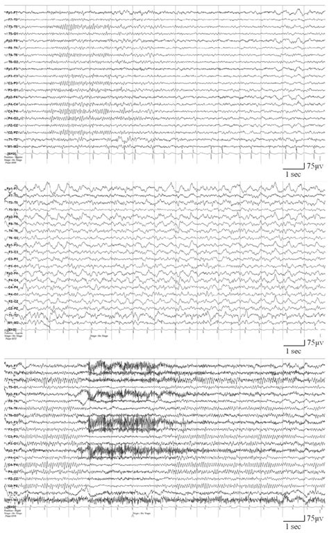 Electroencephalography (EEG) findings. | Download Scientific Diagram