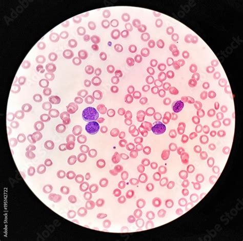 Human blood smear under 100X light microscope with blast cells and normal red blood cells ...