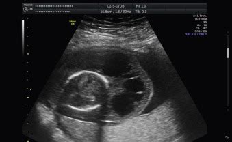 Cystic Hygroma | Radiology Key