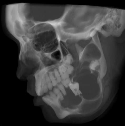 Bubbly jaw lesion. Multicystic ameloblastoma. : Radiology