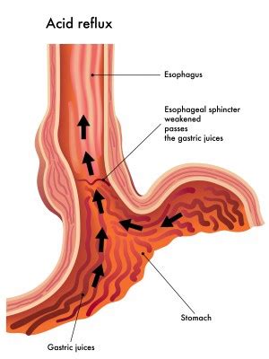 What is Esophagitis? | Dominion Internal Medicine