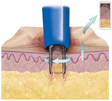 Punch Biopsy Taking Skin Sample – Medical Stock Images Company