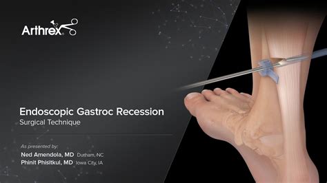 Arthrex - Endoscopic Gastroc Recession