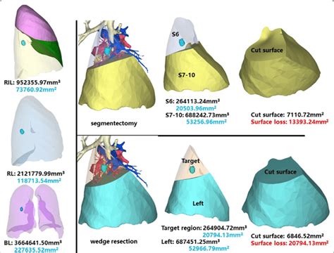 Segmentectomy or wedge resection of RS6. RIL: right inferior lung ...