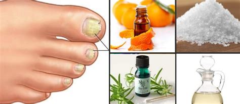 Getting Rid Of Toenail Fungus – A Few Natural Remedies - Women Daily ...