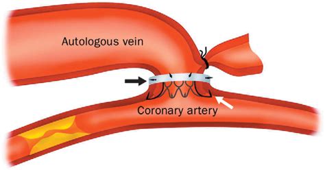 Sutureless mechanical anastomosis of a saphenous vein graft to a coronary artery with a new ...