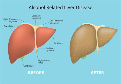 Before And After Alcohol Liver