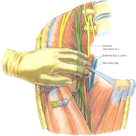 learn anesthesia and have fun: FEMORAL NERVE BLOCK