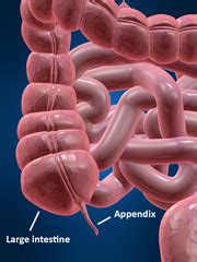 Antibiotics instead of surgery safe for some with appendicitis - Harvard Health