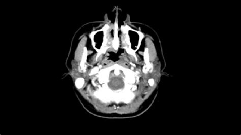 Axial CT showing asymmetry of the fossa of Rossenmuller | Download Scientific Diagram