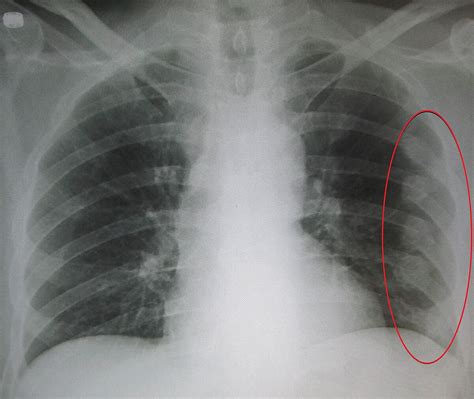 Rib fracture - Wikipedia