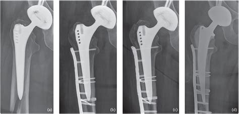 Periprosthetic Fractures Of The Proximal Femur Beyond The Vancouver ...