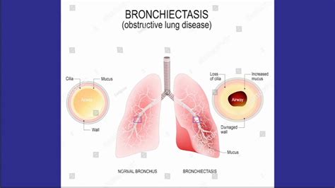 Bronchiectasis - Symptoms, diagnosis, causes and how Temple Health ...