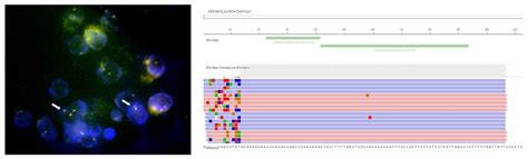 IJMS | Free Full-Text | Deepening the Knowledge of ROS1 Rearrangements in Non-Small Cell Lung ...