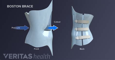 Types of Scoliosis Braces