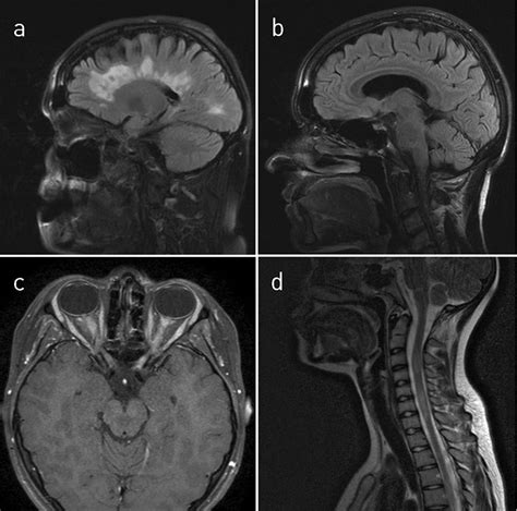 Neuromyelitis optica | Tidsskrift for Den norske legeforening