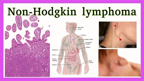 Non-Hodgkin's Lymphoma and Homeopathic Medicines - Doctor Bhatia's Asha Homeopathy