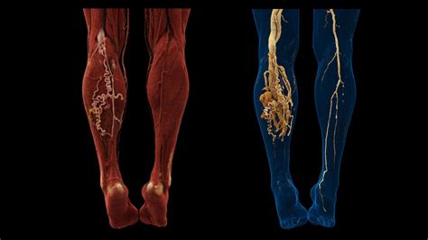 Arteriovenous Malformation of the Left Lower Limb - Siemens Healthineers