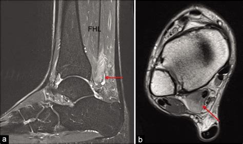 Flexor Hallucis Longus Mri