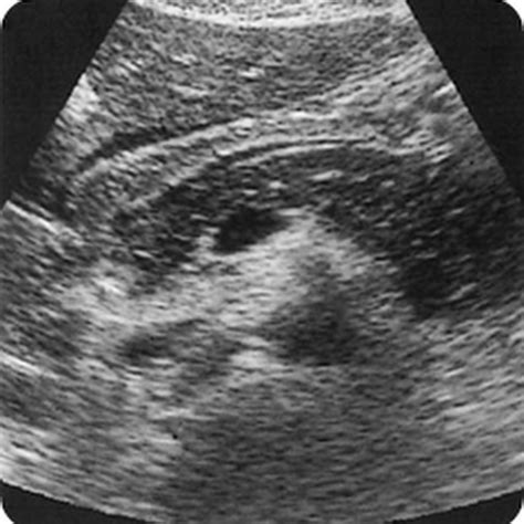 Ultrasound appearances pancreas - Radiology Imaging