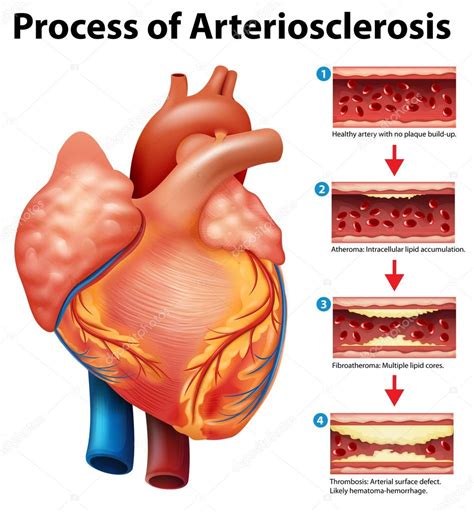 Arteriosclerosis: Causes, Symptoms, Treatment | Patient9