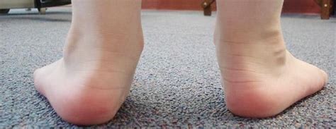 Flat Feet - Greater Houston Foot & Ankle Specialists