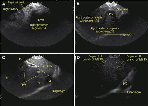 Liver Segment 7 Ultrasound