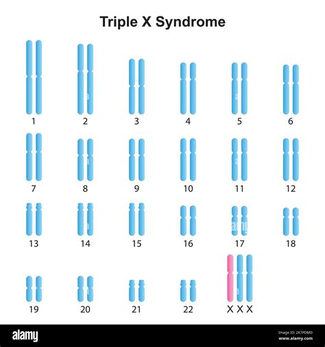 Scientific Designing of Triple X Syndrome (Trisomy X) Karyotype ...