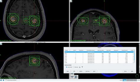 Stereotactic Radiosurgery (SRS) – Localization & Treatment Procedures in Radiation Therapy