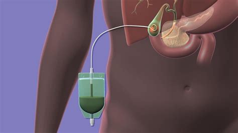 Your Percutaneous Cholecystostomy Drain - YouTube