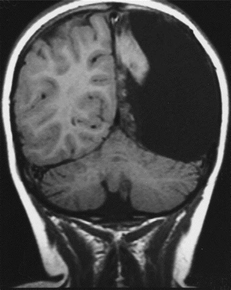 Strange Biology — A three-year-old girl had a hemispherectomy to...