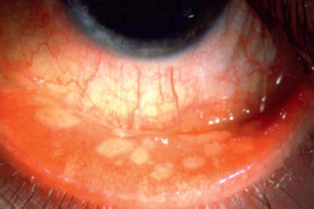 Tumors of the Conjunctiva | Ento Key