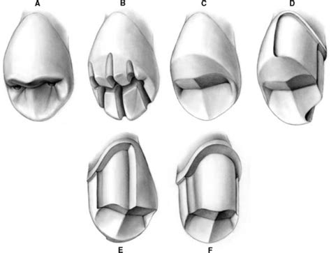 9: THE METAL-CERAMIC CROWN PREPARATION | Pocket Dentistry