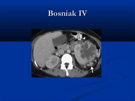 Cystic Renal Disease