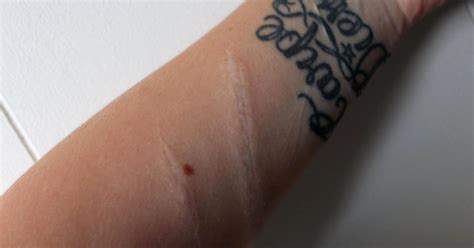 Woman posts scars from suicide attempt to help troubled teens