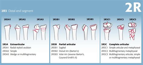 Distal Radius Fracture Types