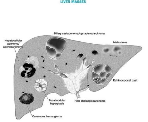 Liver Masses | Medical ultrasound, Diagnostic medical sonography, Radiology imaging