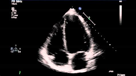 Fetal Echocardiogram