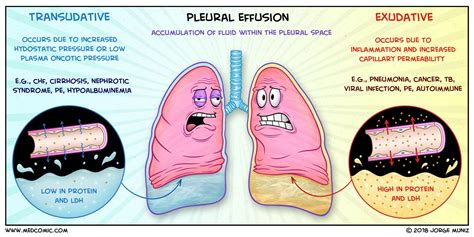 Pleural Effusions: Transudate vs. Exudate BY JORGE MUNIZ, PA-C medcomic.com | Pleural effusion ...