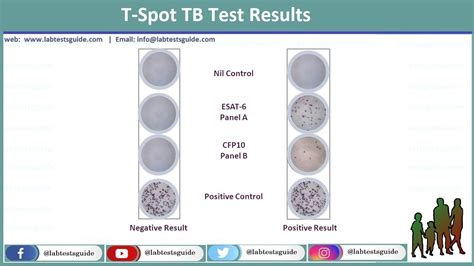 T-Spot Test Procedure, Results And Interpretation | Lab Tests Guide