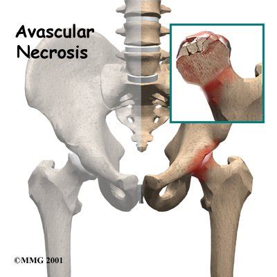 Physical Therapy in Conway for Avascular Necrosis of the Hip