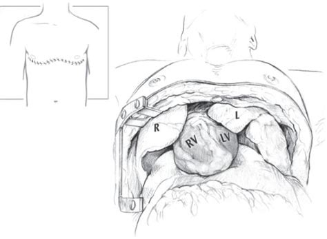 Clamshell Thoracotomy