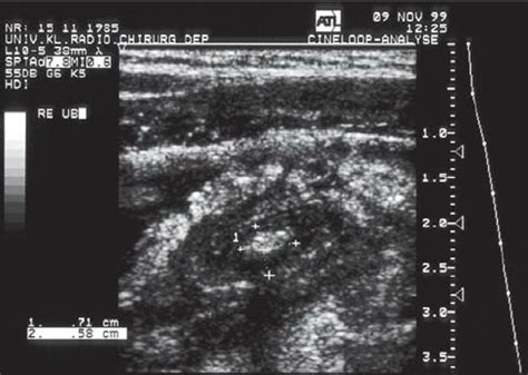 4D: Sonographic view of fecalith in transverse section | Download Scientific Diagram