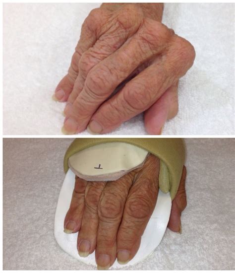 Custom splint for rheumatoid arthritis to help align the hand and fingers. | Hand splints ...