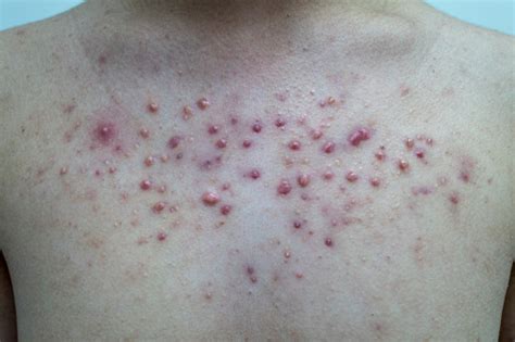 Acne And Keloid Scars Stock Photo - Download Image Now - Acne, Chest ...