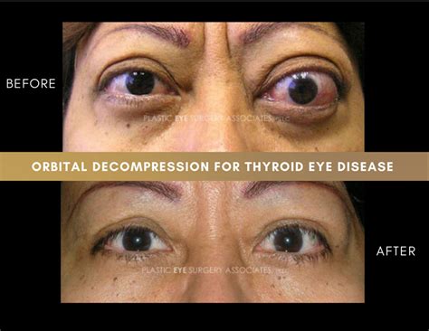 Thyroid Eye Disease Photos - Plastic Eye Surgery Associates