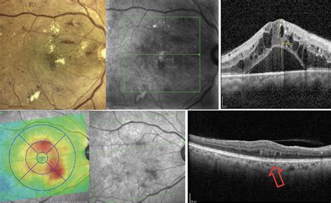 OCT: An Indispensable Tool in Retina Care