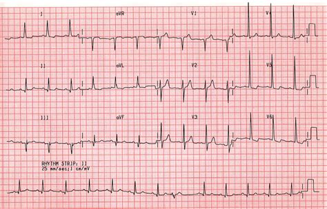 Case A4. Old Inferior Infarction; Left Ventricular Hypertrophy. St Emlyn's ECG Library.