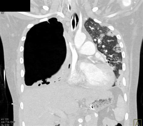 Hydropneumothorax Right Chest - Chest Case Studies - CTisus CT Scanning