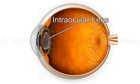 Intraocular Lens (IOL) Options - Oregon Eye Consultants